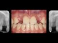Congenitally Missing Lateral Incisors