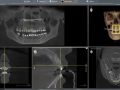 Mobile #8 in Ortho with Lingual Bone Loss