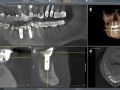 CT Pre-planning For Implant Removal Under Bridge