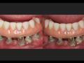 Fixed Immediate Full Arch Reconstruction-Salvaging an All-On-4 Failure