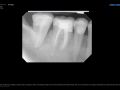 Nothing Special- Ext, CBCT, PRF