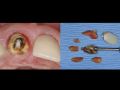 Immediate Implant with Buccal Perforation