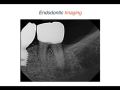 Endodontic Case 24: Internal resorption-Diagnosis