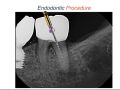 Endodontic Case 24: Internal Resorption - Procedure