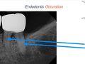 Endodontic Case 24: Internal Resorption - Obturation