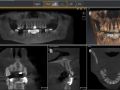 Using SICAT Implant Software to Complete Radiology Review 3