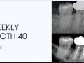 Week 5 - Weekly Tooth 40