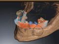 Planning for Guided Overdenture Implants