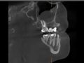 NP Incidental Findings in CBCT