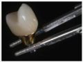 Zirconia Clinical Cases