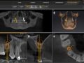 Using CBCT to Evaluate Site for an Implant - 2