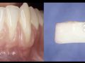 Soft Tissue Grafting around Teeth and Implants - A Paradigm Shift with Dr. Farhad Boltchi
